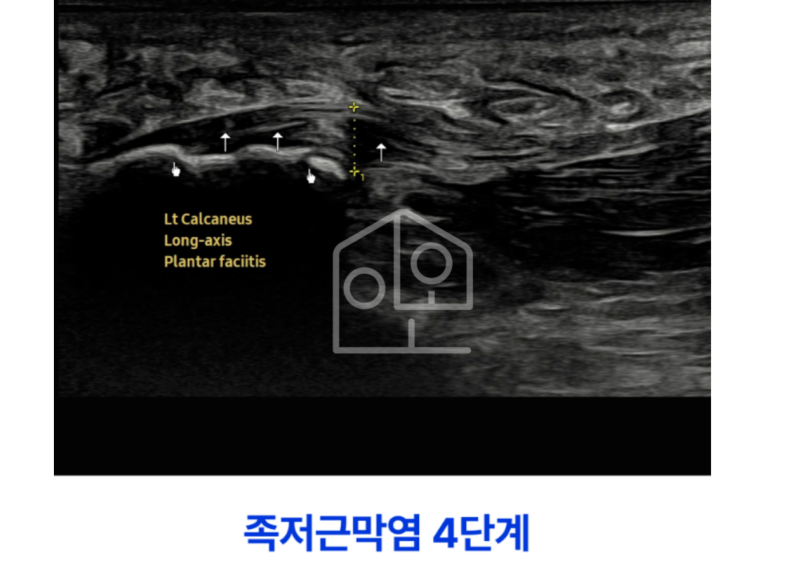 [족저근막염 DNA(PDRN) 주사 치료] 아피톡신, 라이넥과 장단점 비교하기