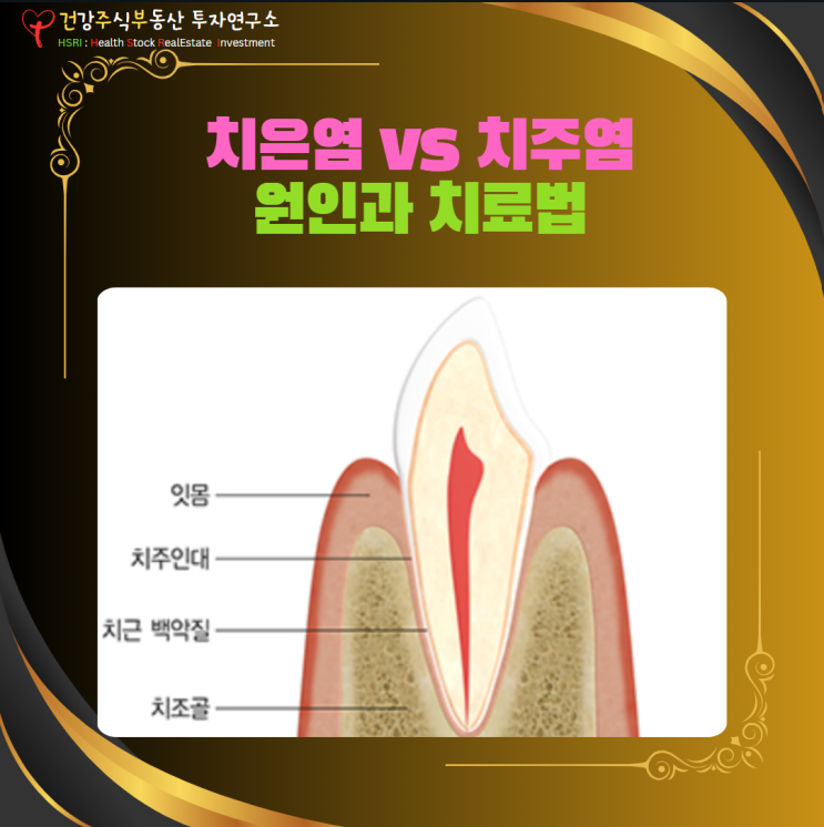  치주질환(잇몸병) : 치은염 vs 치주염의 원인과 치료 방법