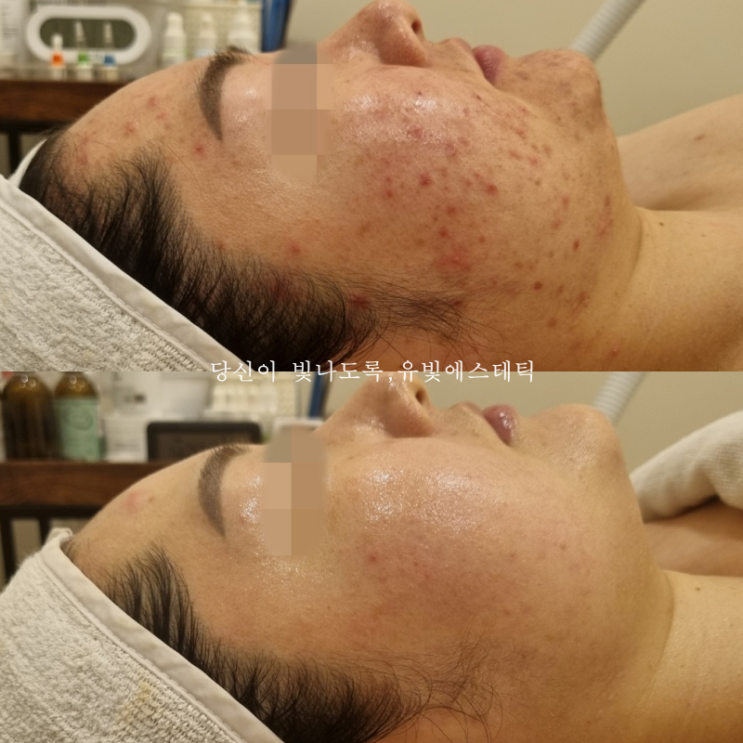 지축 원흥 삼송 여드름 피부 약초필 알라딘 필링 전문 유빛에스테틱
