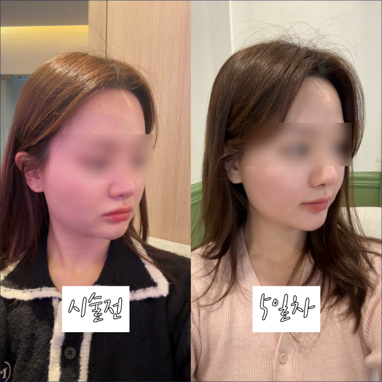  신논현피부과 강남 티타늄리프팅 스쿱주사로 얼굴형 관리 효과 솔직 후기