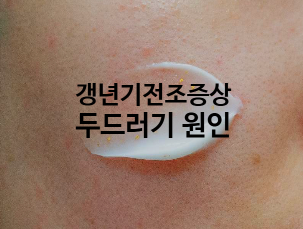 갱년기전조증상으로 두드러기 생기는 이유