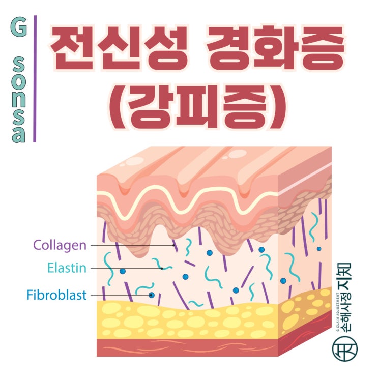  전신성 경화증(강피증), 피부만 딱딱해지는 게 아니에요! - [자가면역질환, AlDa]