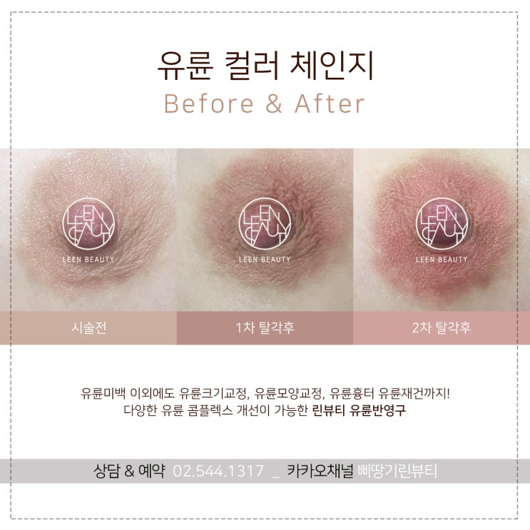 유두, 유륜반영구 만족스러운 선택을 위한 가이드