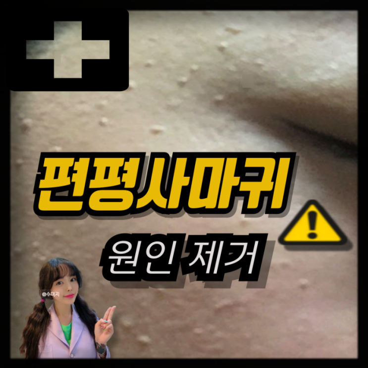  편평사마귀 원인 편평사마귀 면역치료 율무 사마귀 레이저 치료 눈밑 손등 사마귀