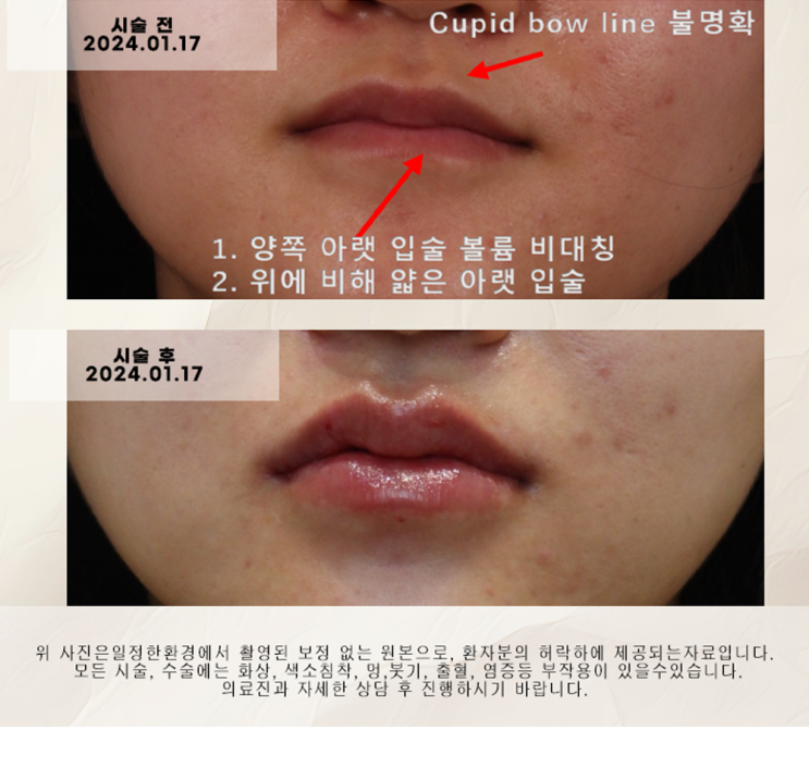  성수역 입술필러 전후 사진 Case 4