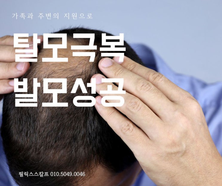  탈모극복을 위한 가족과 주변의 지원: 발모성공의 핵심