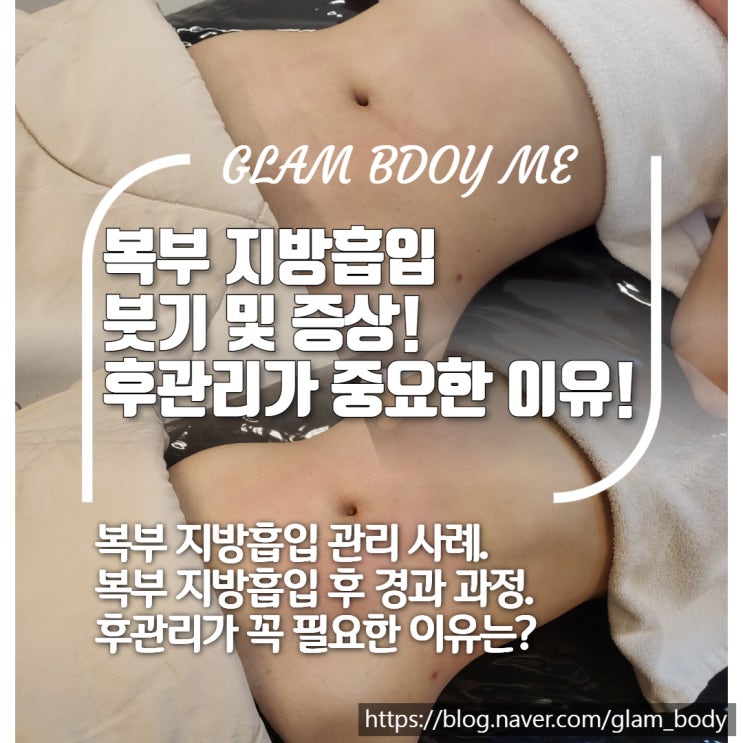  복부 지방흡입 붓기 관리 전후 비교!