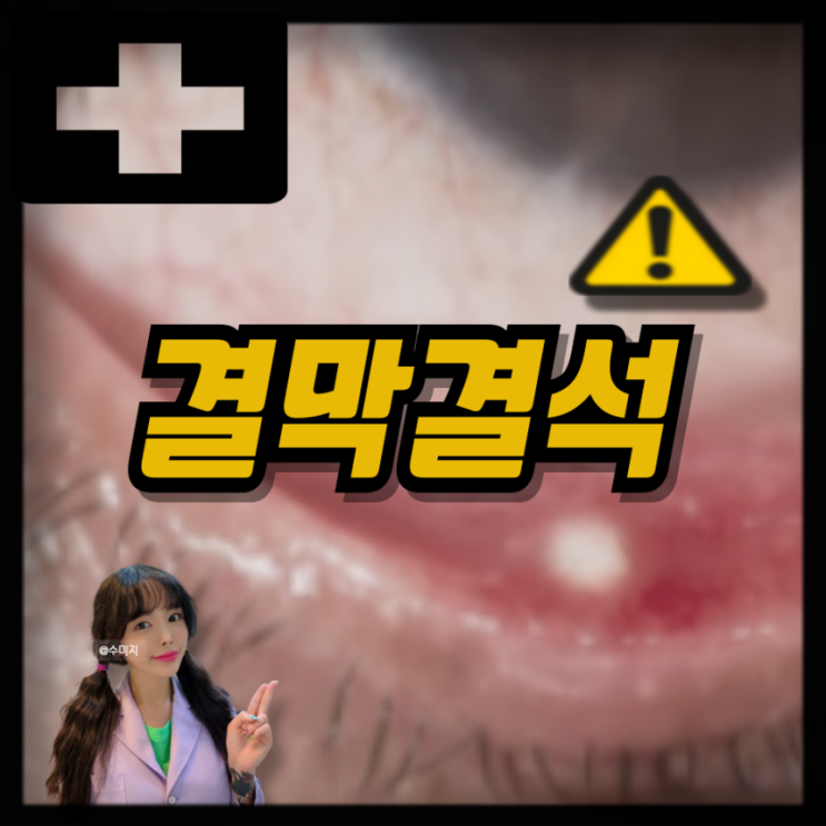  결막결석 원인 증상 눈 건조 이물감 눈 결석