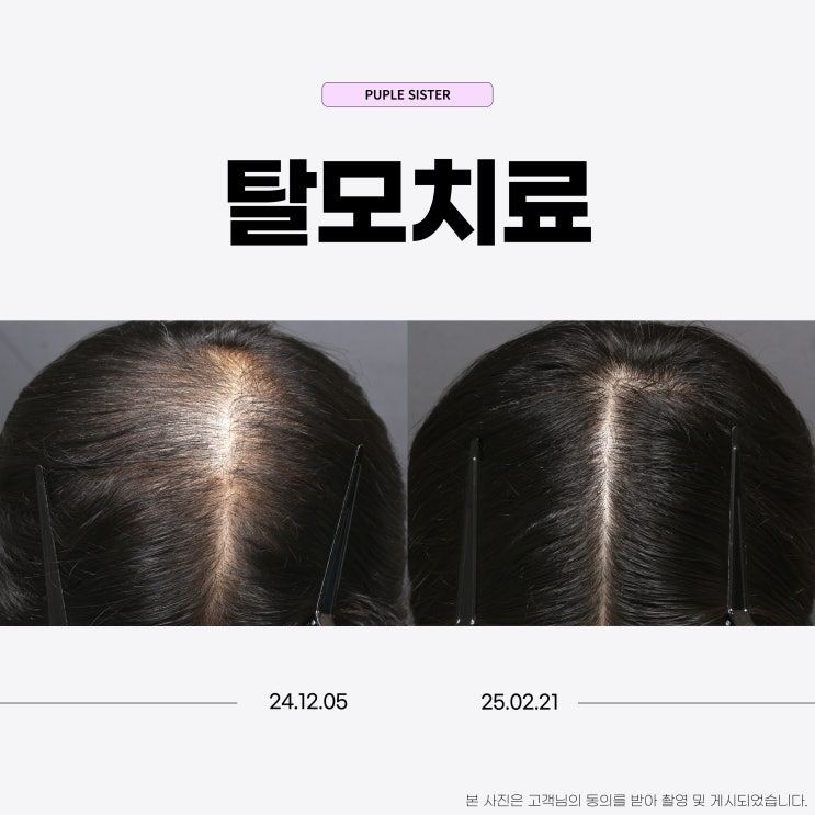  파주탈모치료 처음으로 효과 본 후기