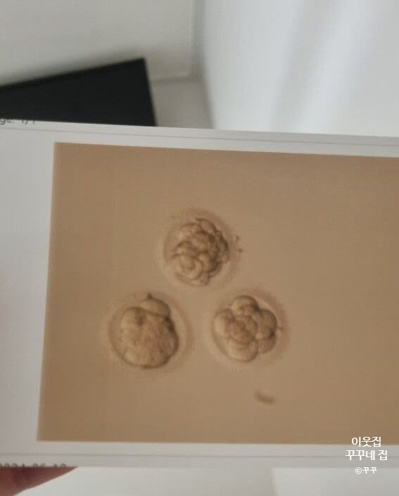  [시험관] 수정된 배아의 등급과 모양(3일배양 5일배양)