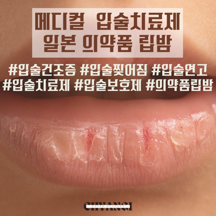  입술 찢어짐 연고 입술 각질 연고 일본 의약품 립밤 내돈내산 후기