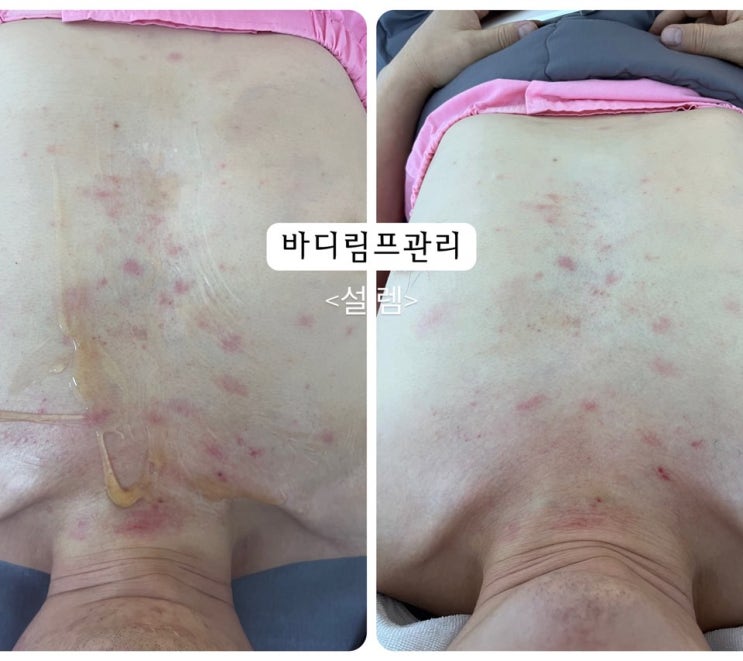 영주 피부관리 바디관리 림프관리 찐 후기