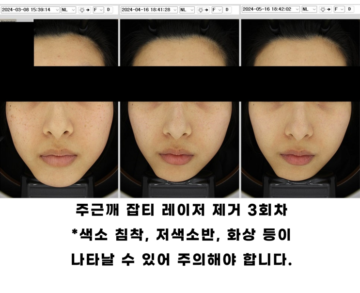  피코토닝 후기, 돈낭비 하지 않기 위한 TIP 3가지