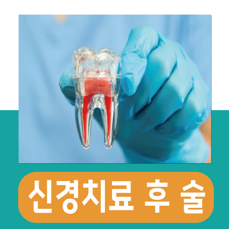 이빨 신경치료 후 술, 음주 담배 기간 언제부터
