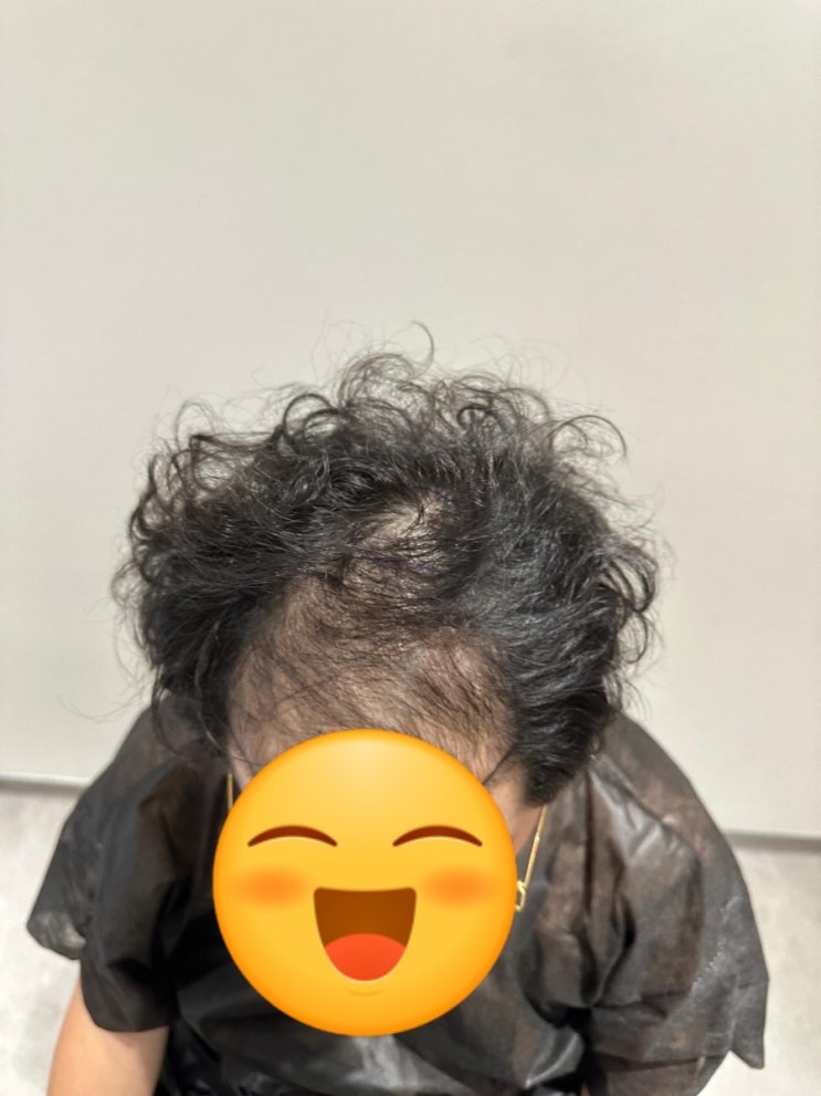  30대 터키 모발이식 여정 후기