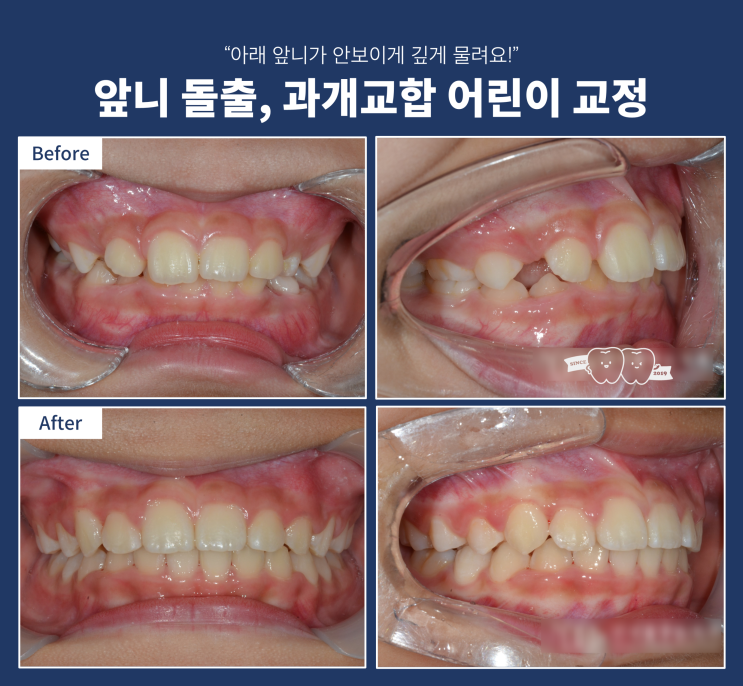 어린이 과개교합 왜, 어떻게 치료 왜 해야 할까?(Why & How) 어린이 과개교합 왜, 어떻게 치료 왜 해야 할까?(Why & How)