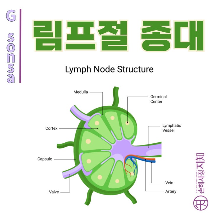  림프절 종대(Lymphadenopathy) - 면역 시스템의 신호등 - [자가면역질환, AlDa]