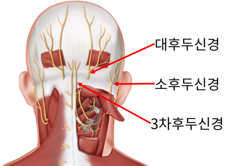  뒷통수가 찌릿하다면? 후두신경통 증상과 원인