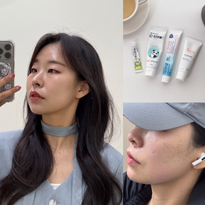 강남 사마귀피부과 거우침치료 편평사마귀 제거 관리법