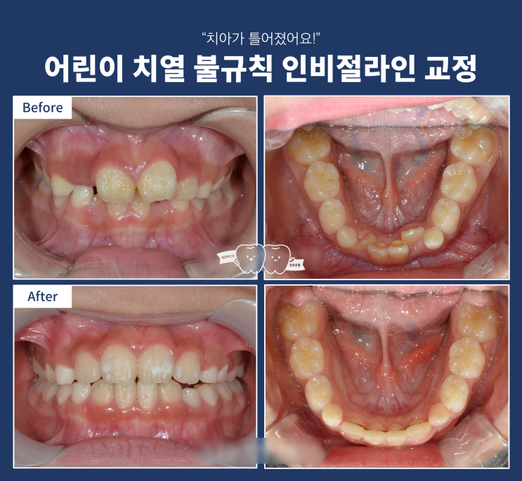 어린이 인비절라인 퍼스트로 어디까지 치료가 될까? 어린이 치아 불규칙 인비절라인 투명교정 치료 과정 어린이 인비절라인 퍼스트로 어디까지 치료가 될까? 어린이 치아 불규칙 인비절라인 투명교정 치료 과정