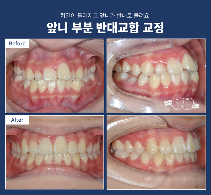 앞니가 거꾸로 물리고, 치아가 틀어진 경우 교정치료, 위턱 확장 치료, RPE, 청소년 확장 치료 앞니가 거꾸로 물리고, 치아가 틀어진 경우 교정치료, 위턱 확장 치료, RPE, 청소년 확장 치료