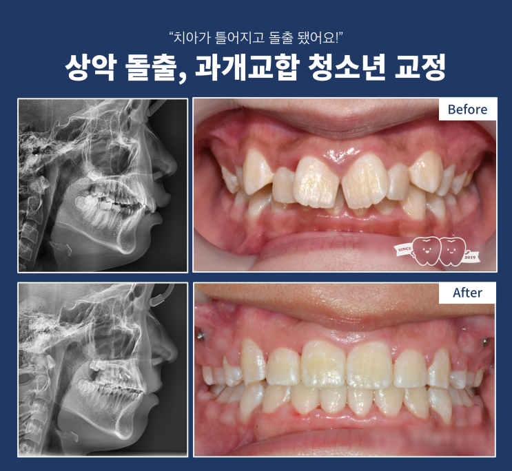 위 앞니 돌출과 과개교합, 무턱교정은 어떻게 할까? 위턱만 발치하는 교정은? 위 앞니 돌출과 과개교합, 무턱교정은 어떻게 할까? 위턱만 발치하는 교정은?