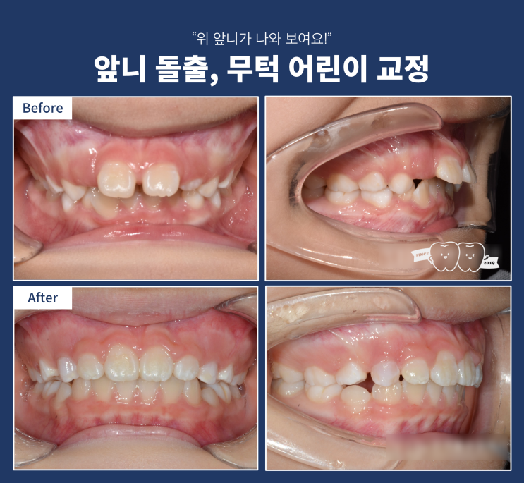 어린이 무턱 교정, 앞니 돌출 어떻게 치료해야 하나? 어린이 무턱 교정, 앞니 돌출 어떻게 치료해야 하나?