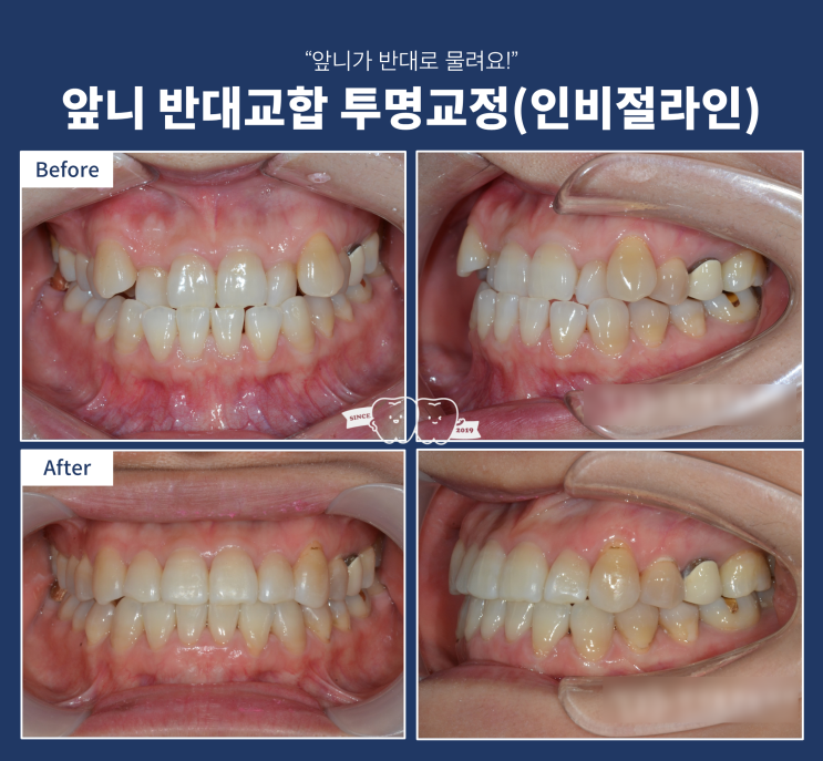 앞니 반대교합 교정치료 인비절라인 효과는? 투명교정 장점 앞니 반대교합 교정치료 인비절라인 효과는? 투명교정 장점