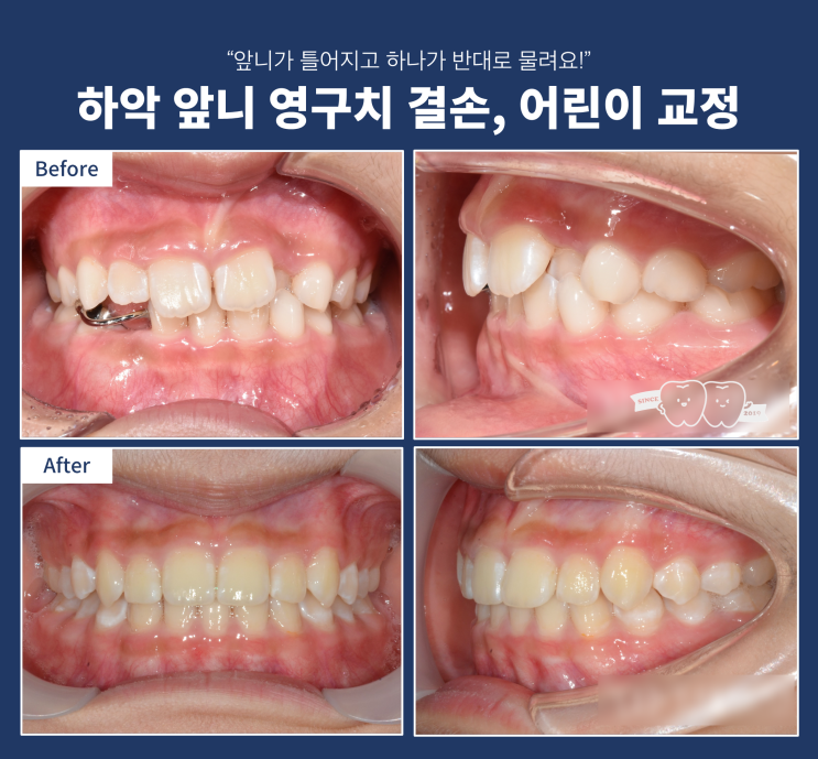 2차 교정 안 하는 어린이 교정? 교정은 꼭 한 번만 해야 하는가? 2차 교정 안 하는 어린이 교정? 교정은 꼭 한 번만 해야 하는가?