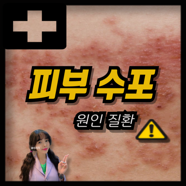  피부 수포 원인 질환! 성인 농가진 천연두 수두 대상포진 증상