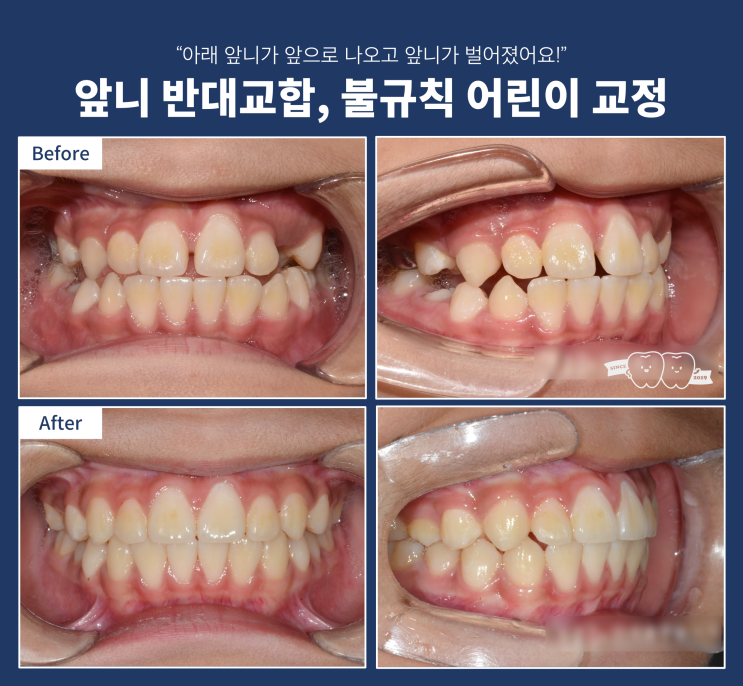 앞니 절단교합 부정교합 치료하기, 어린이 앞니가 벌어진 경우 치료 앞니 절단교합 부정교합 치료하기, 어린이 앞니가 벌어진 경우 치료
