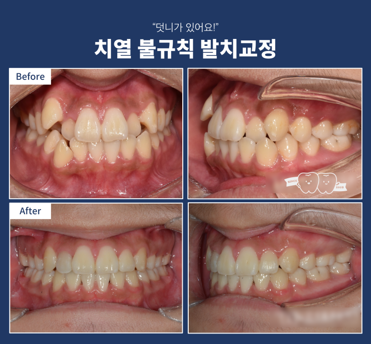 아랫입술 돌출 원인은? 아랫잇몸 돌출이나 위 앞니 돌출이 문제일 수 있다! 아랫입술 돌출 원인은? 아랫잇몸 돌출이나 위 앞니 돌출이 문제일 수 있다!