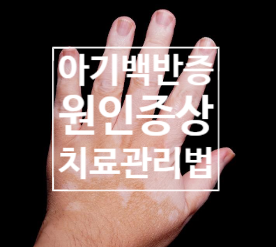 아기 백반증 원인 유전 증상 병원 치료 관리 방법