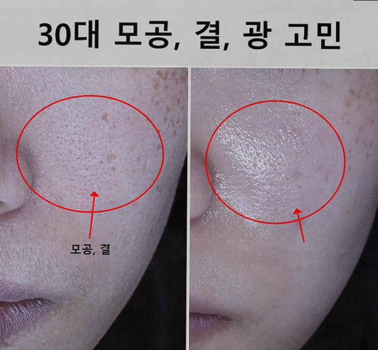  수원피부관리, 결혼식 위해 애띠애에서 스페셜 관리 받아요