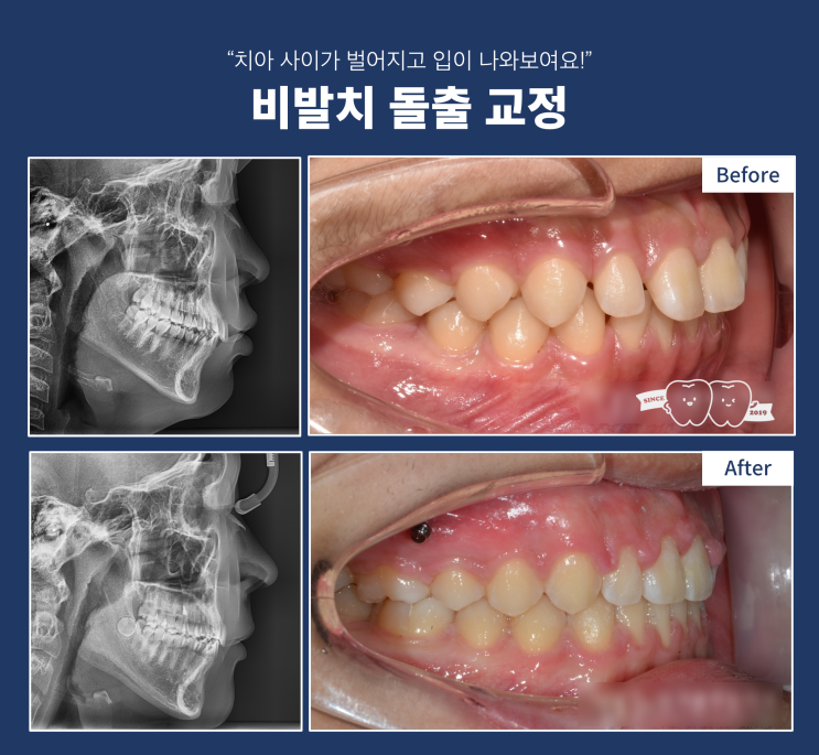 발치 없이 돌출 해결하기, 치아 사이 공간이 있으면 어떤 문제가 있을까? 발치 없이 돌출 해결하기, 치아 사이 공간이 있으면 어떤 문제가 있을까?