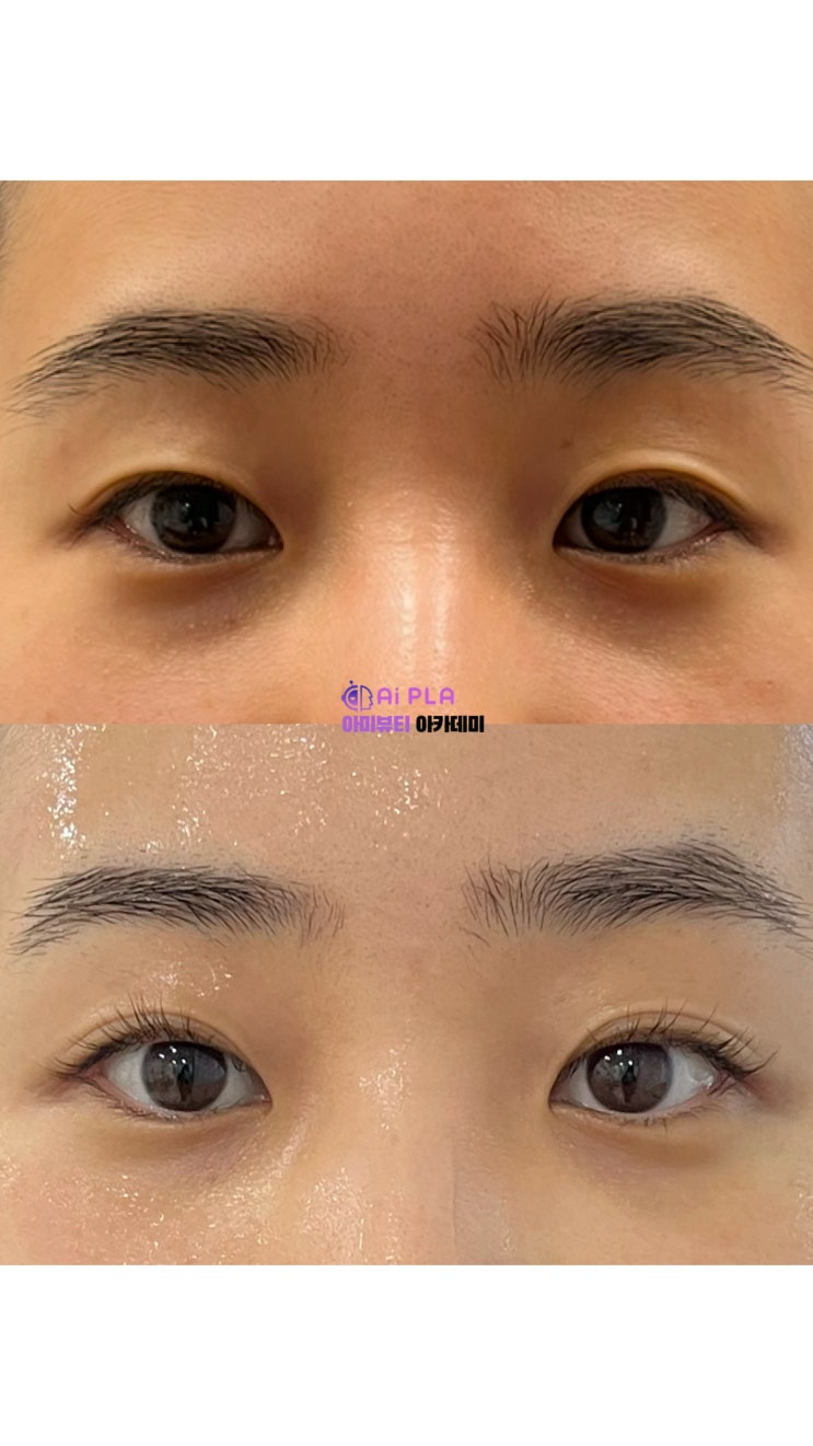  전국 각지에서 찾아오는 아미뷰티, 플라즈마 쌍꺼풀의 놀라운 효과