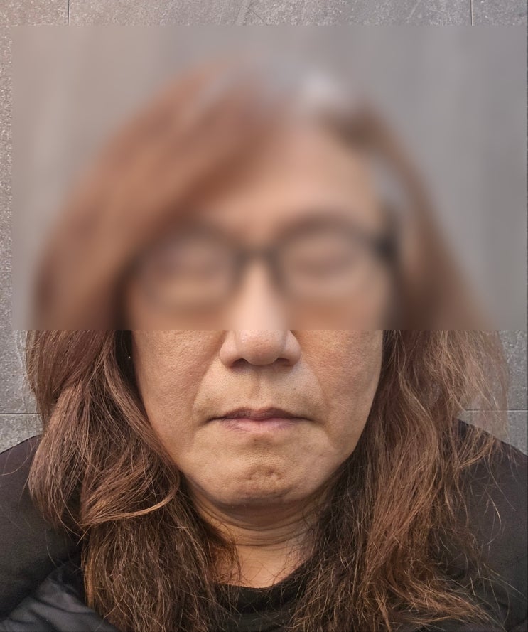  50대 남자 쥬베룩볼륨 팔자주름 1회차 반병 효과