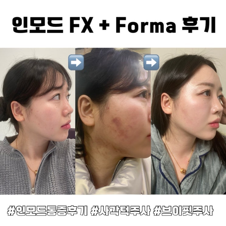  인모드 리프팅 FX + Forma 솔직 후기 효과 통증까지 자세히