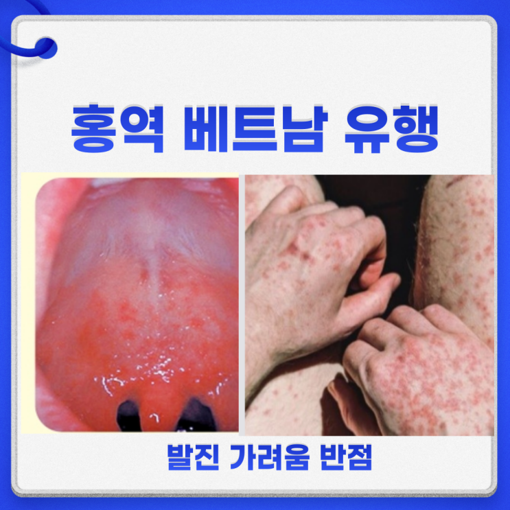  홍역 베트남 유행 증상 예방접종 시기 전염 예방법