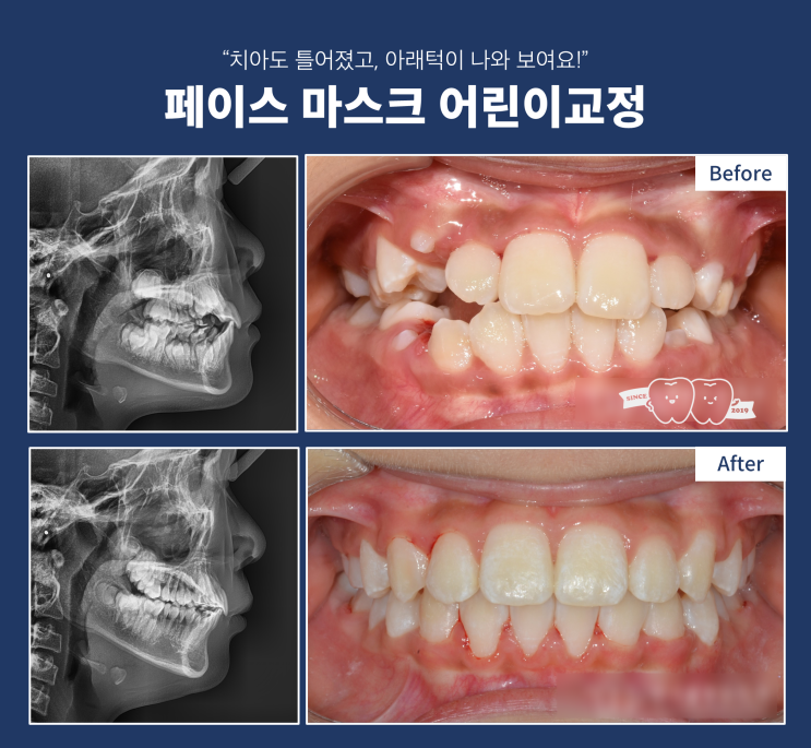 어린이 페이스마스크 턱교정의 필요성, 턱교정 후 치아 배열이 필요한 이유! 어린이 페이스마스크 턱교정의 필요성, 턱교정 후 치아 배열이 필요한 이유!