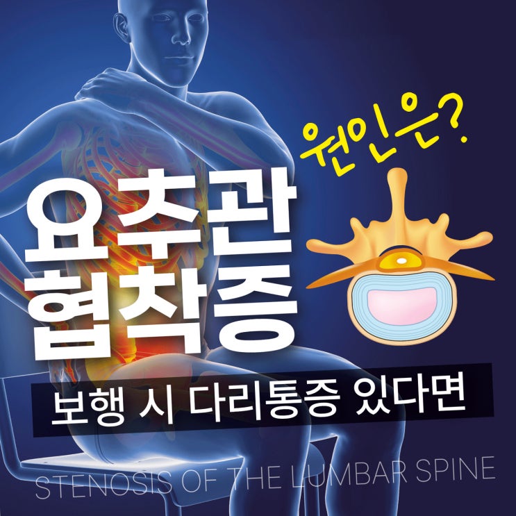  석촌역근처정형외과 계속되는 척추신경 압박 협착증 이럴땐