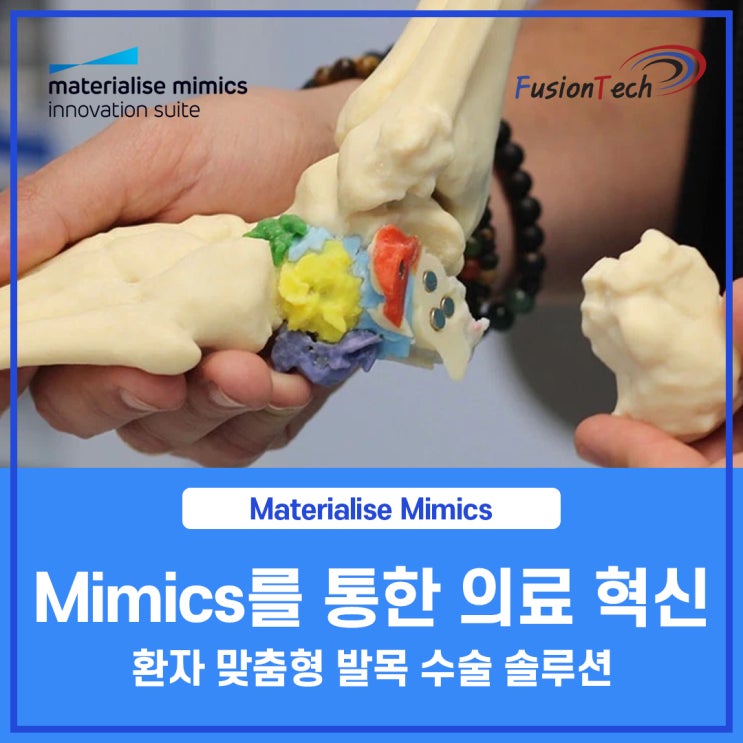  [Materialise S/W] Mimics를 통한 의료 혁신 : 환자 맞춤형 발목 수술 솔루션
