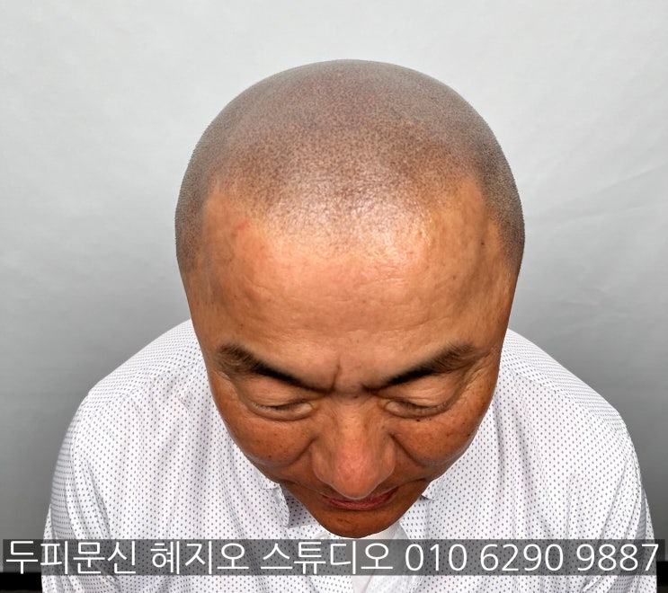  부천 남성 모발이식, PRP, 레이저 보다 저렴한 두피페인팅 추천하는 이유