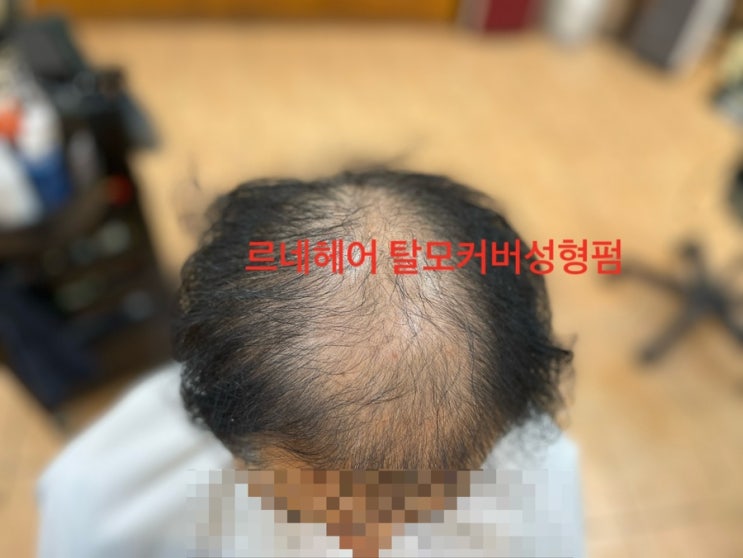  남자정수리 심한전체탈모와모발손상 으라차차 모태미남으로 거듭나볼까 부산사상르네시떼미용실[ 개금주례구덕백양덕천만덕하단다대김해거제양정기장반송대연남천영도사하명지전포수영망미금정장전울산양산]