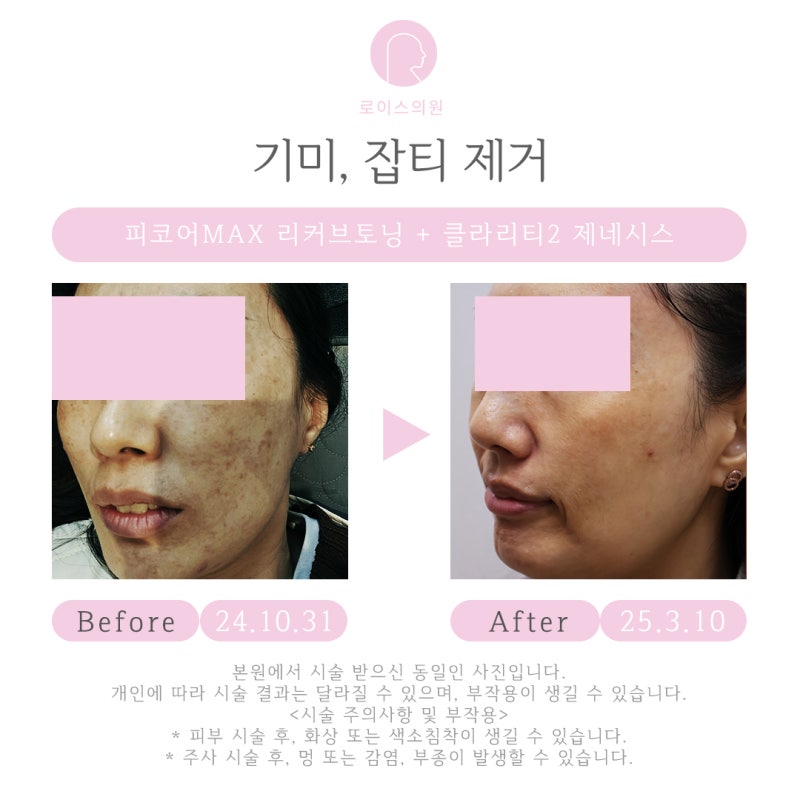 역북동 피부과 기미 잡티 관리 (진료과목 피부과) 전후사진, 가격