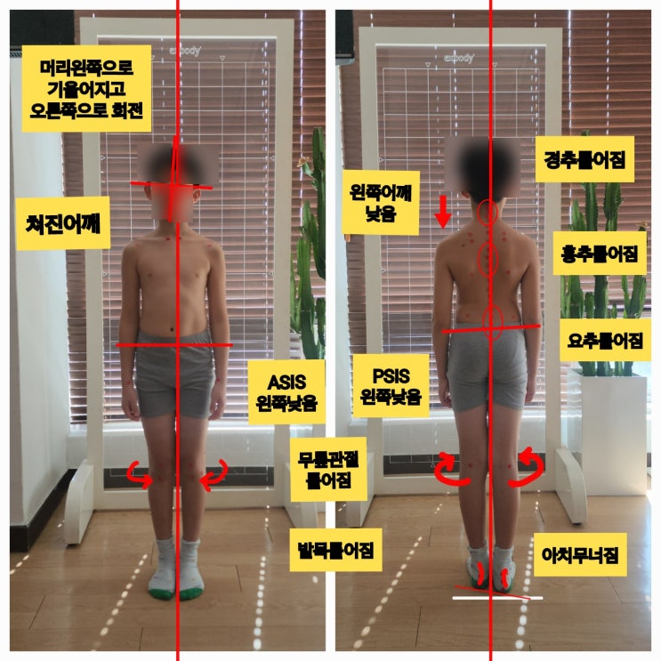  부산 동래 키즈 필라테스, 우리아이 자세와 보행이 이상하다면?