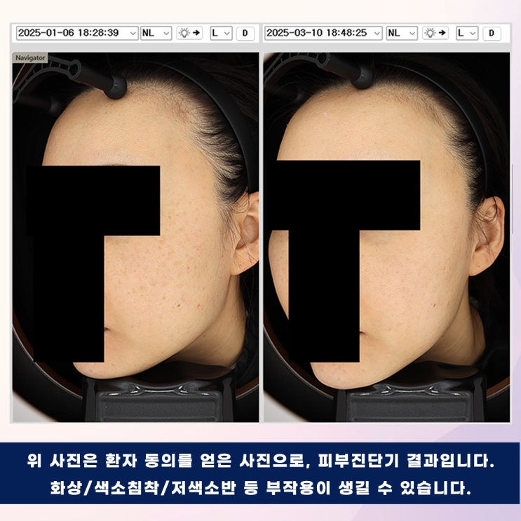  피코플러스 피코슈어 줌패스 가격과 전후 사진