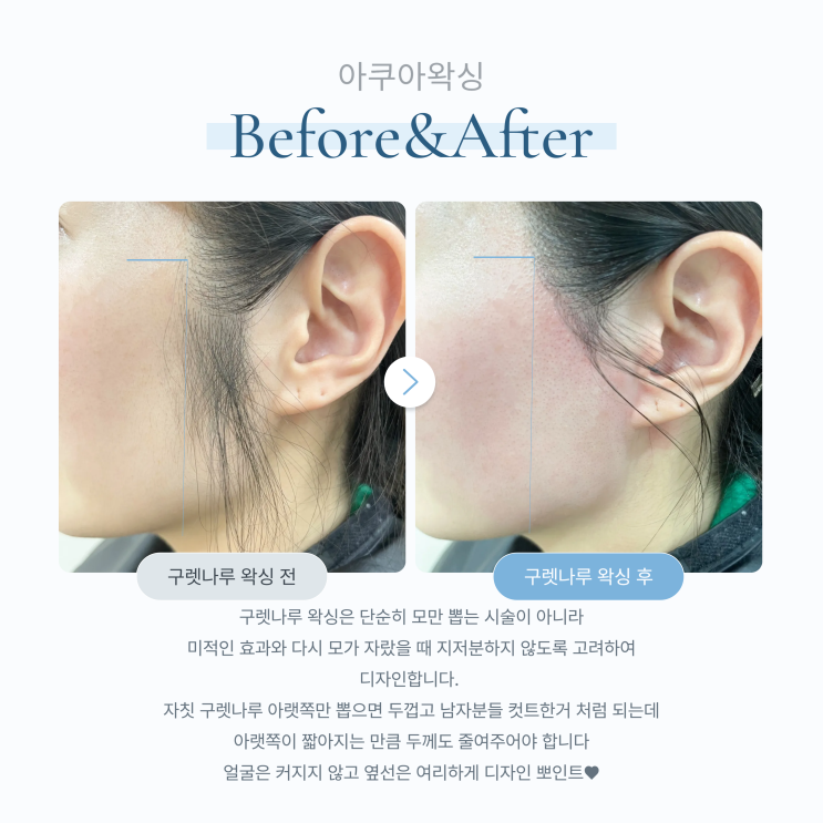  예비신부왁싱 (헤어라인 / 뒷목 / 구렛나루 ) 아쿠아왁싱 추천