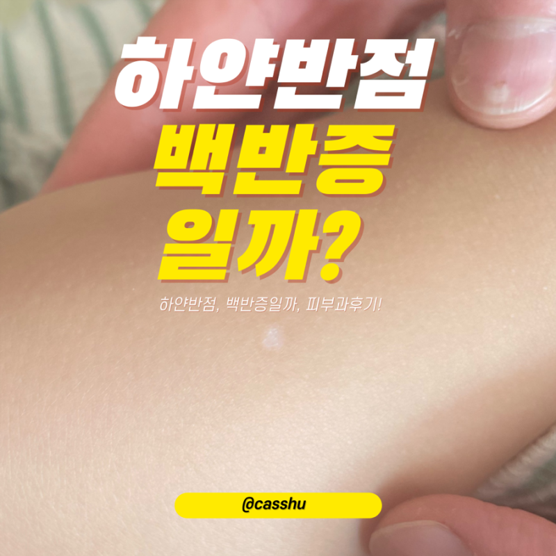 아기 백반증일까 증상 및 피부과 후기