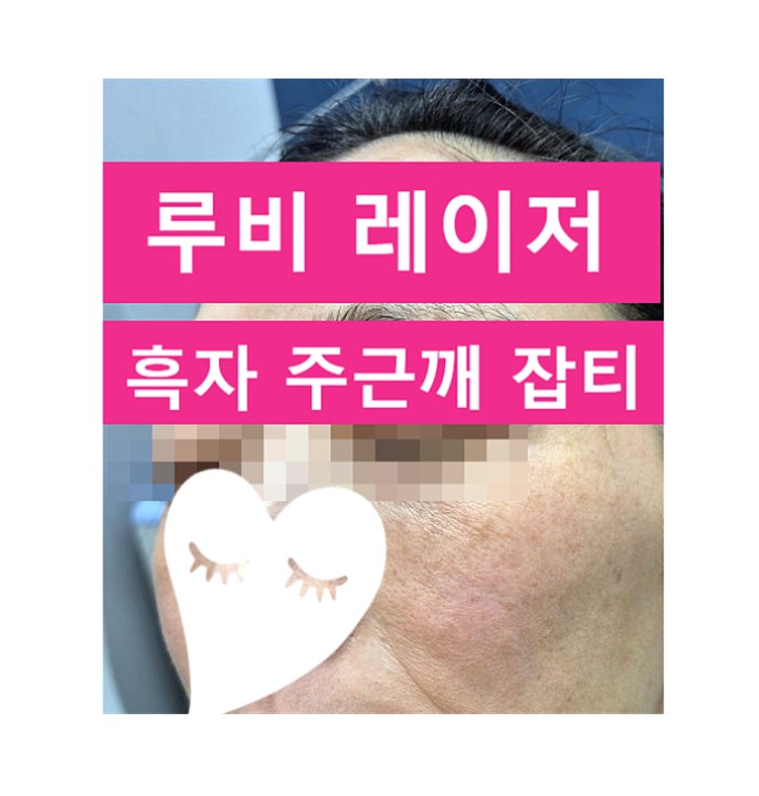  제니는 루비 앨범으로 새 역사 흑자는 루비레이저로 새 피부 (의사직접작성(